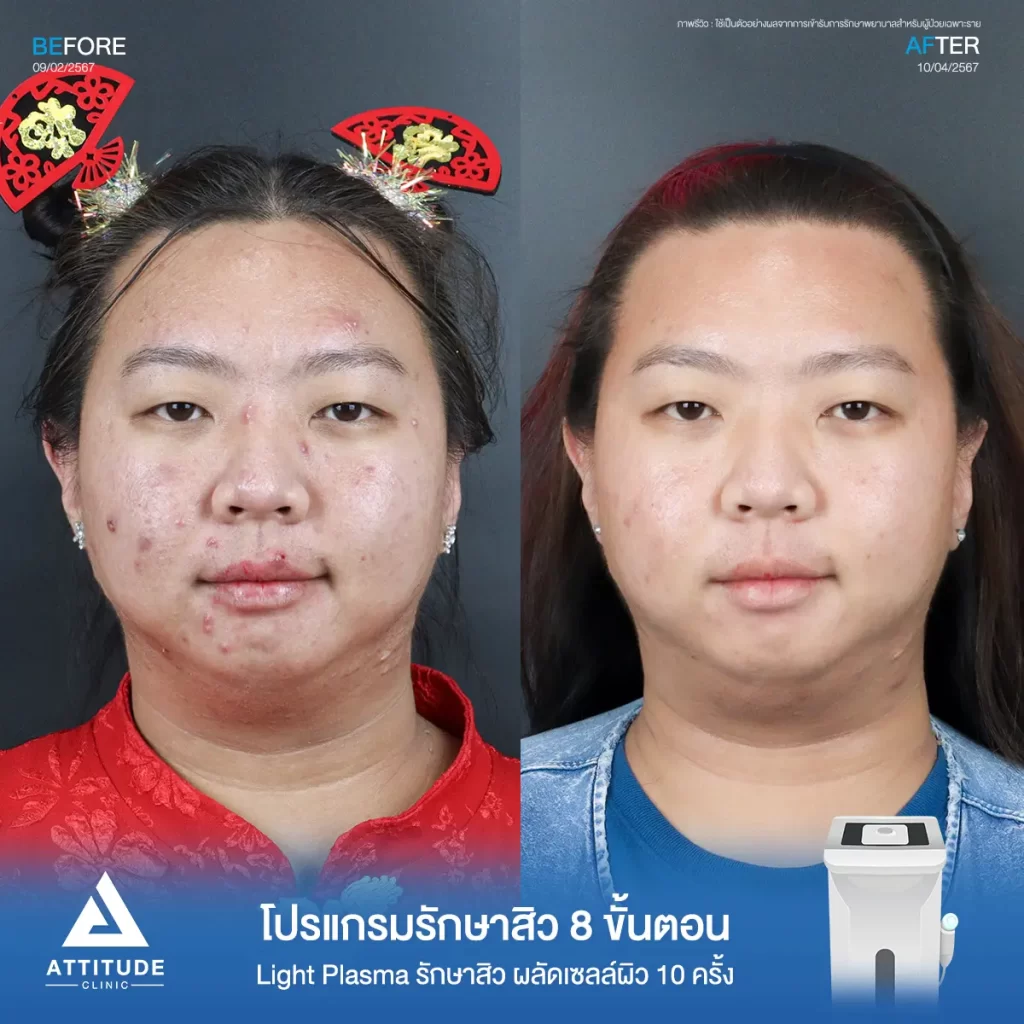 รีวิวรักษาสิวคุณแพ็คซี่ ด้วยการฉายแสง Light Plasma 8 ขั้นตอน จำนวน 1 ครั้ง รักษาสิวอักเสบ สิวอุดตัน สิวผดเม็ดเล็กๆ และรอยสิวทั่วใบหน้าจนถึงช่วงคอที่ Attitude Clinic