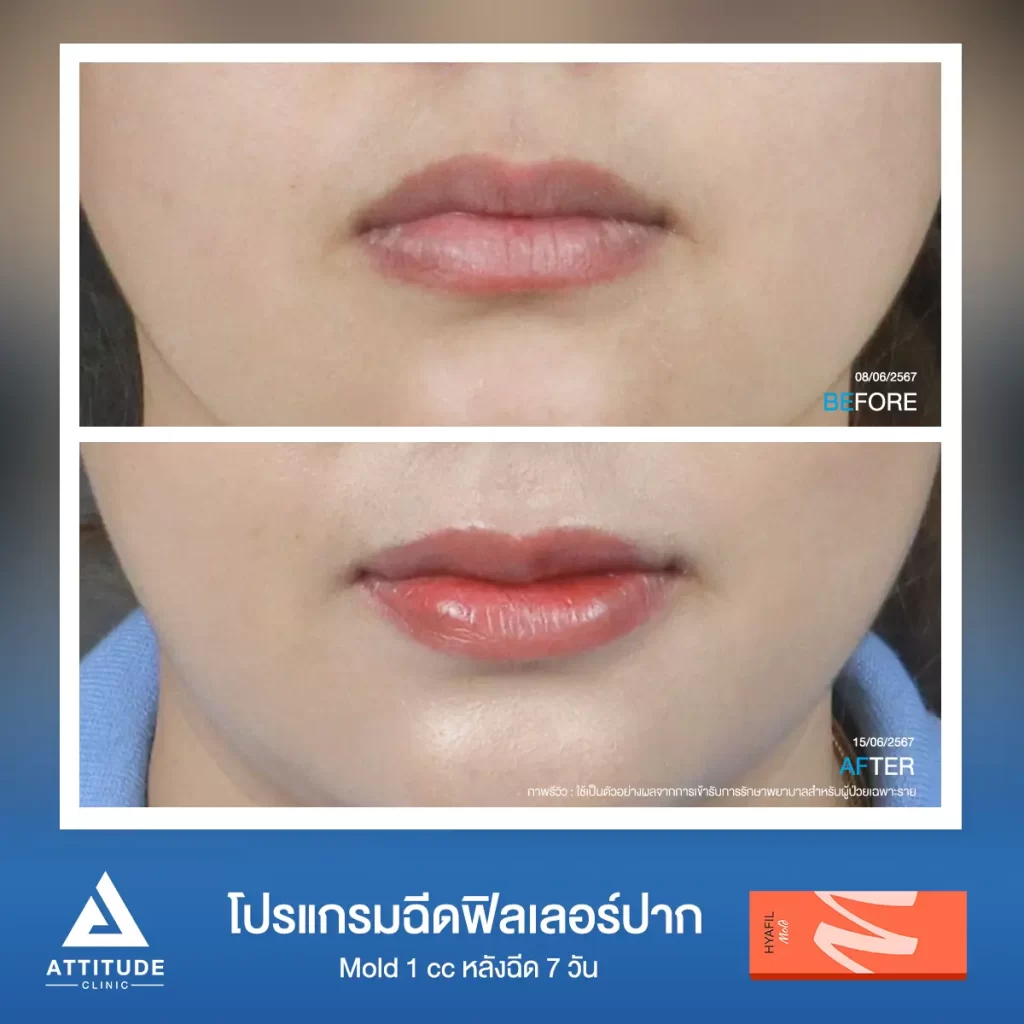 รีวิวโปรแกรมฉีดฟิลเลอร์ปากคุณมิกซ์ รุ่น M จำนวน 1 cc หลังฉีด 7 วัน เติมเต็มให้อวบอิ่ม เป็นทรงสวยตามที่ต้องการ มุมปากยก ได้รูป ริมฝีปากเรียบเนียน ดูเป็นธรรมชาติที่ Attitude Clinic