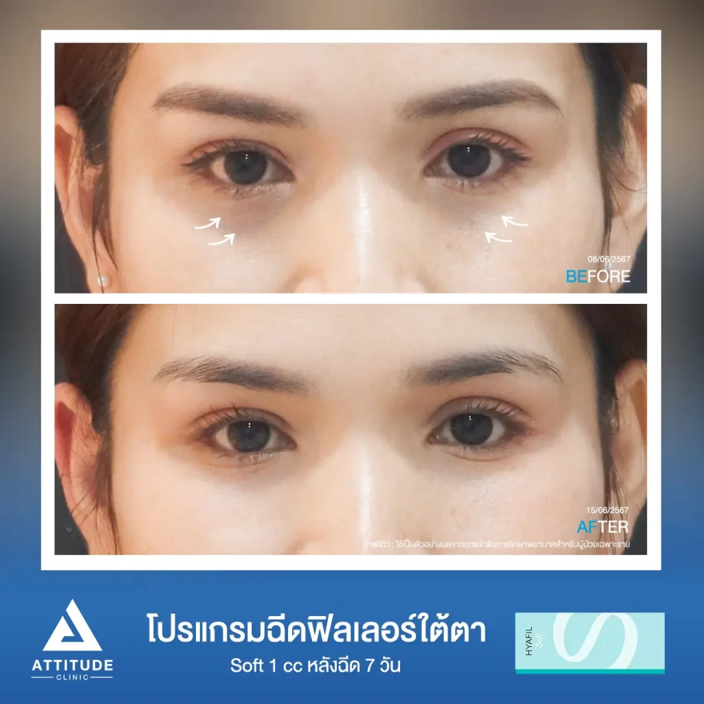 รีวิวโปรแกรมฉีดฟิลเลอร์ใต้ตาคุณน้ำตาล รุ่น S จำนวน 1 cc หลังฉีด 7 วัน เติมเต็มร่องใต้ตาให้อิ่มฟู แก้ใต้ตาหมองคล้ำทำกลับมาสดใส ลดริ้วรอยเล็กๆ ให้ตาตาดูเรียบเนียนที่ Attitude Clinic