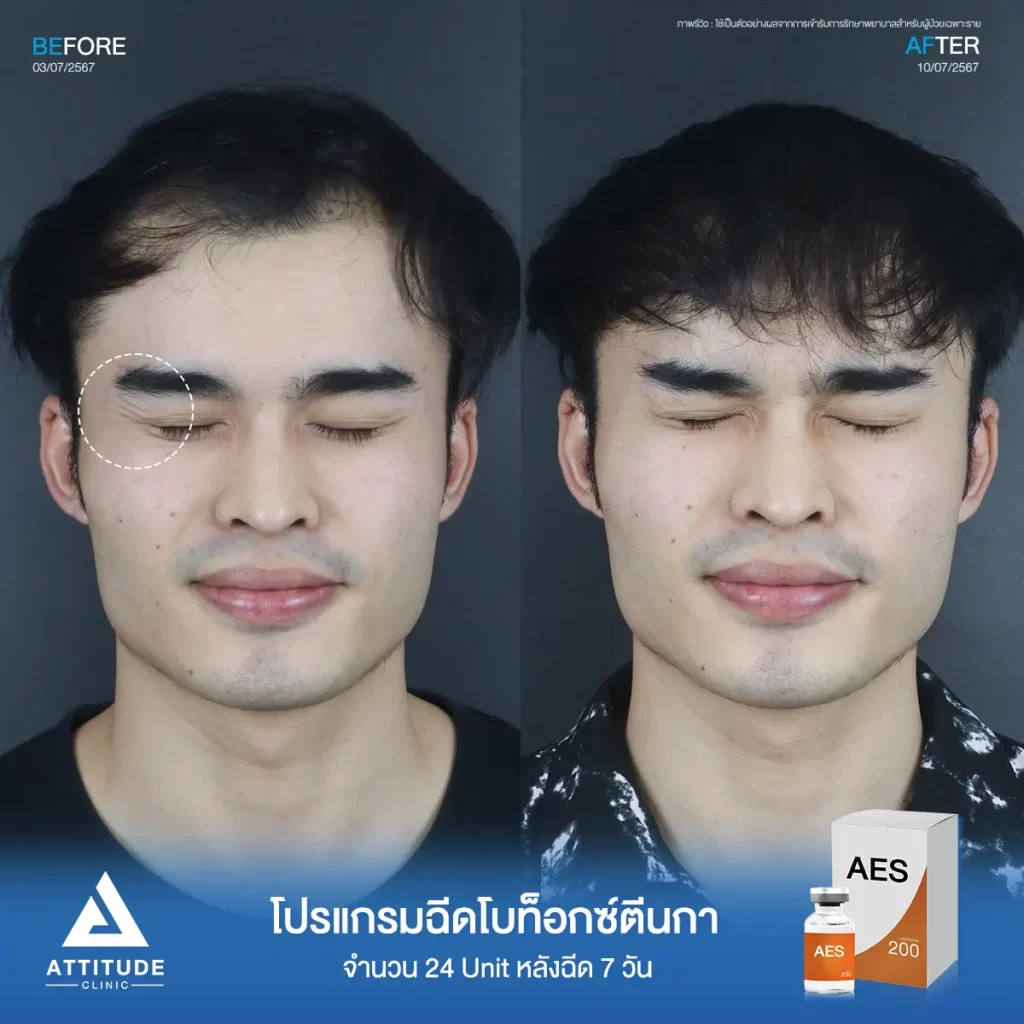 รีวิวโปรแกรมฉีดโบท็อกซ์ตีนกาคุณแชมป์ จำนวน 24 Unit อัปเดตหลังฉีด 7 วัน ฉีดในปริมาณที่เหมาะสมให้ริ้วรอยตีนกาดูจางลง แต่หน้าดูไม่แข็งตึงกับคุณหมอที่ Attitude Clinic