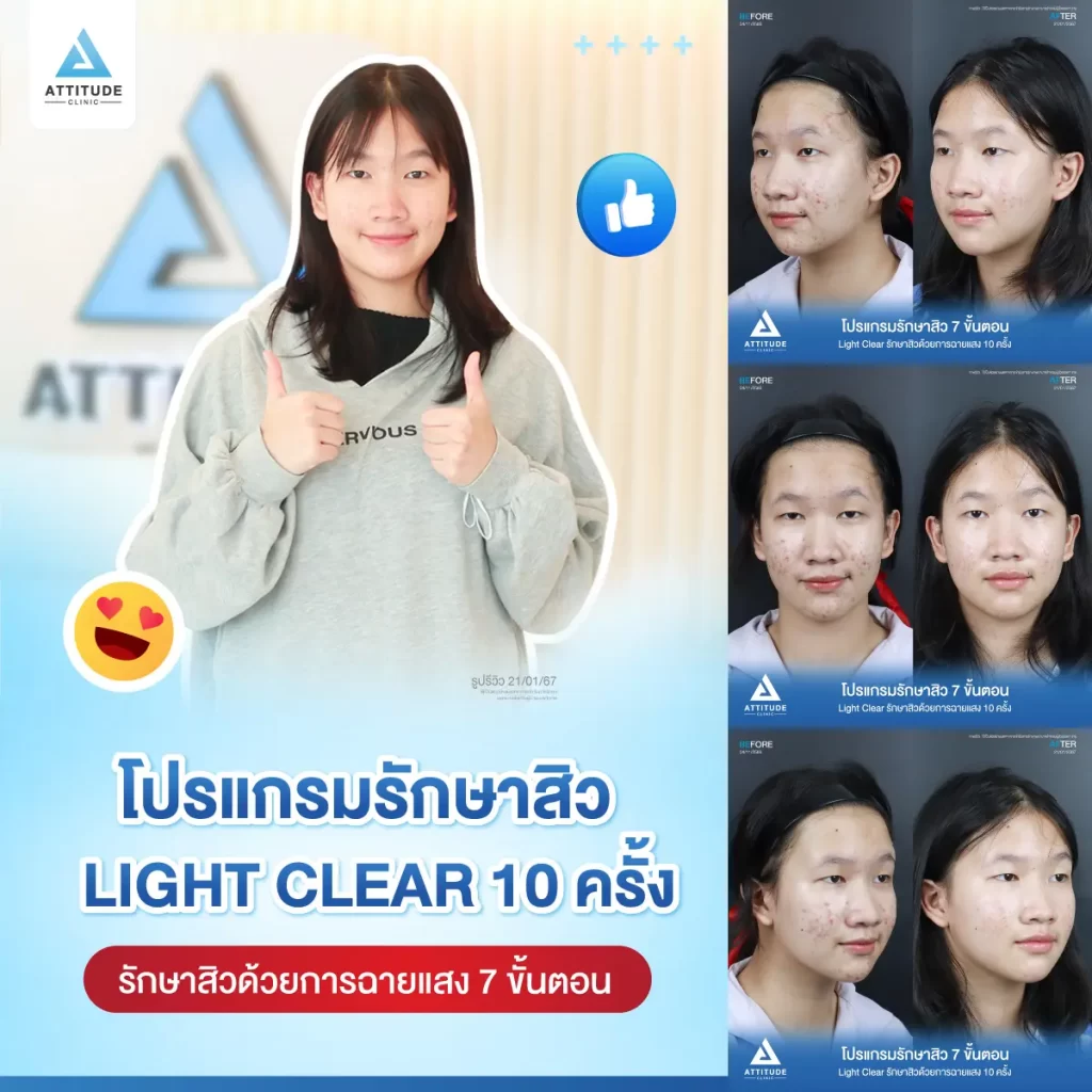 รีวิวรักษาสิวน้องตุ๊กตา ด้วยการฉายแสง Light Clear 7 ขั้นตอน จำนวน 10 ครั้ง รักษาสิวฮอร์โมน สิวอักเสบ สิวอุดตันเม็ดเล็กๆ รอยแดงทั่วใบหน้า โดยเฉพาะ 2 ข้างแก้ม และคางที่ Attitude Clinic