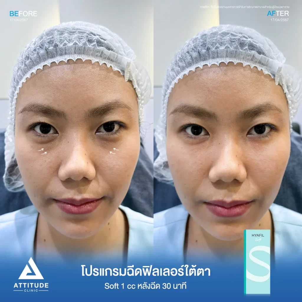 รีวิวโปรแกรมฉีดฟิลเลอร์ใต้ตาคุณแทน รุ่น S จำนวน 1 cc หลังฉีด 30 นาที เติมเต็มร่องใต้ตาให้อิ่มฟู ลดริ้วรอยเล็กๆ แก้ใต้ตาหมองคล้ำให้สดใส เรียบเนียน ดูเป็นธรรมชาติที่ Attitude Clinic