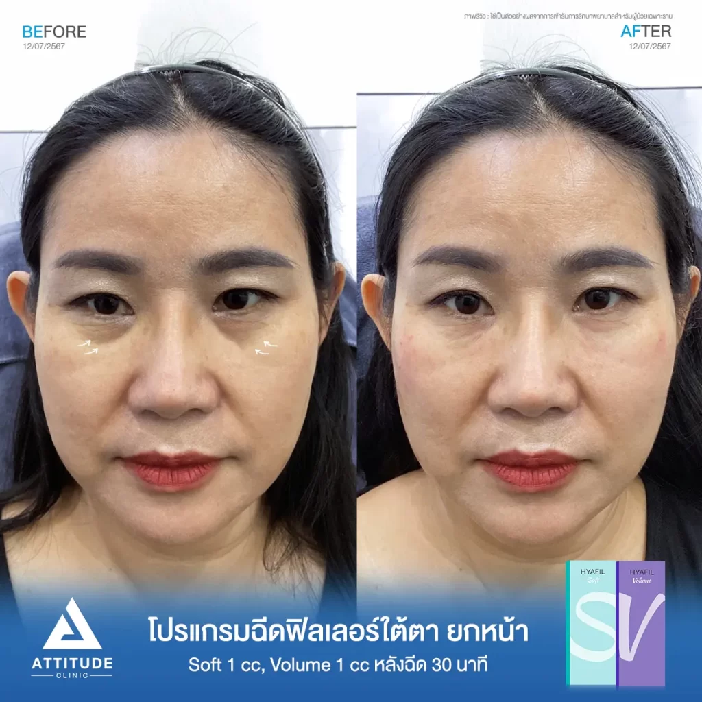 รีวิวโปรแกรมฉีดฟิลเลอร์ใต้ตา ยกหน้าคุณดวงเดือน รุ่น S และรุ่น V จำนวน 2 cc หลังฉีด 30 นาที เติมเต็มร่องลึกใต้ตาให้อิ่มฟู แก้ใต้ตาหมองคล้ำให้สดใส ลดริ้วรอยเล็กๆ รอบดวงตา ปรับรูปหน้า ยกกระชับผิวให้ดูอ่อนเยาว์เป็นธรรมชาติที่ Attitude Clinic