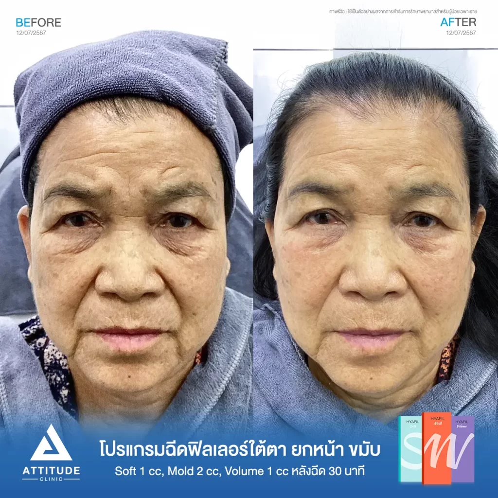 รีวิวโปรแกรมฉีดฟิลเลอร์ใต้ตา ยกหน้า ขมับ คุณวันดารุ่น S รุ่น M และรุ่น V จำนวน 4 cc หลังฉีด 30 นาที เติมเต็มร่องลึกใต้ตาให้อิ่มฟู ลดริ้วรอยเล็กๆ รอบดวงตา แก้ไข ปรับรูปหน้า แก้ปัญหาขมับตอบ ให้หน้าดูสดใสเป็นธรรมชาติที่ Attitude Clinic