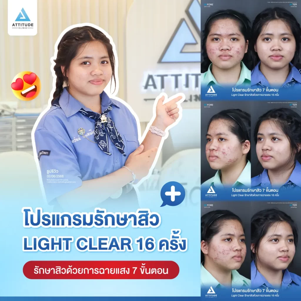 รีวิวรักษาสิวน้องจุฑารัตน์ ด้วยการฉายแสง Light Clear 7 ขั้นตอน จำนวน 16 ครั้ง รักษาสิวฮอร์โมน สิวอักเสบ สิวอุดตัน รอยแดงสิวทั่วใบหน้าที่ Attitude Clinic