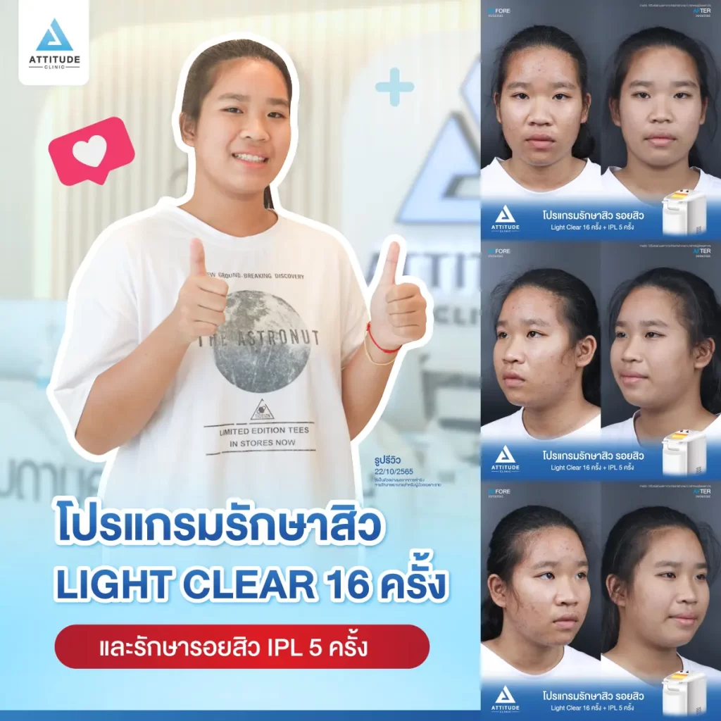รีวิวรักษาสิวน้องณัฐชารีย์ ด้วยการฉายแสง Light Clear 7 ขั้นตอน จำนวน 16 ครั้ง และทำ IPL หน้าใส ลดรอยสิว จำนวน 5 ครั้ง รักษาสิวสิวอุดตัน สิวผดเม็ดเล็กๆ ทั่วใบหน้า และลำคอที่ Attitude Clinic