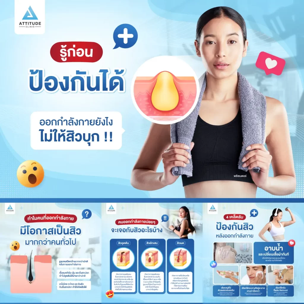 รู้ก่อน ป้องกันได้ ออกกำลังกายยังไงไม่ให้สิวบุก