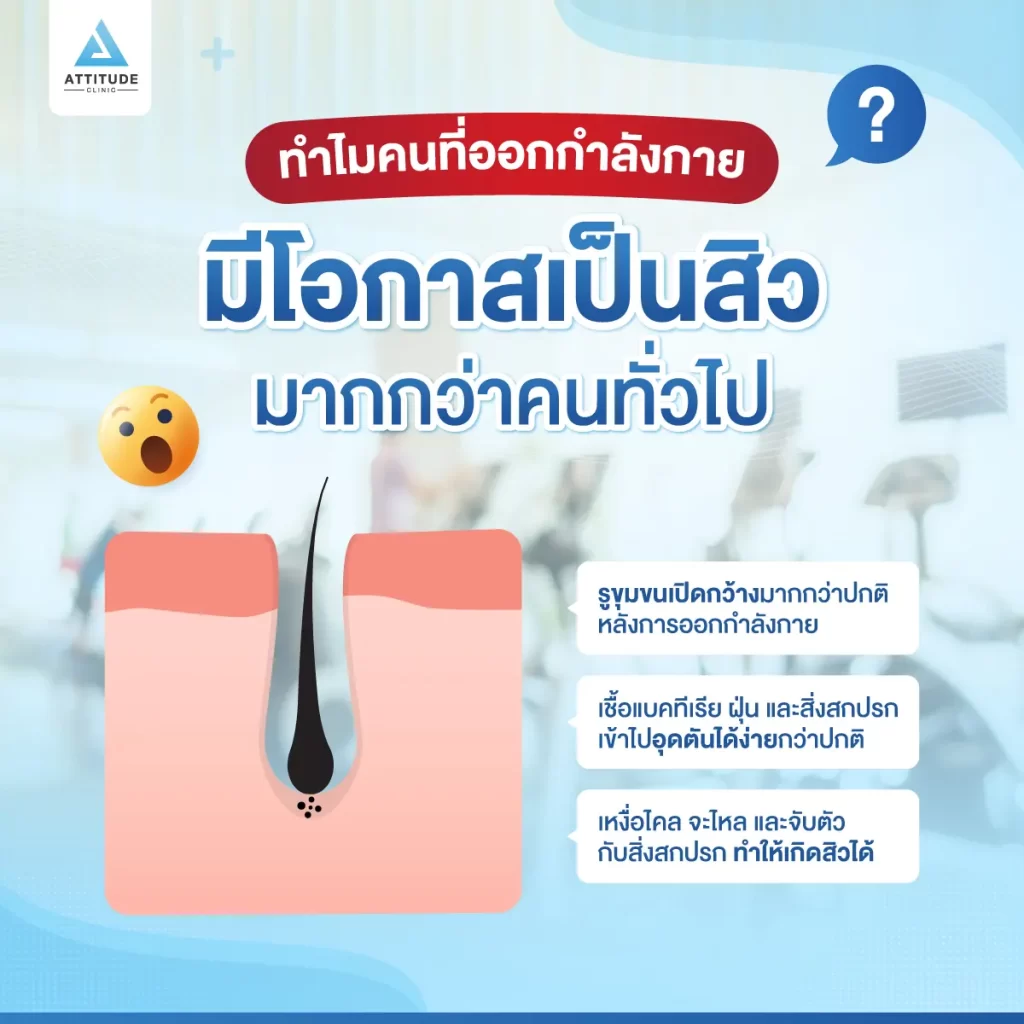 รู้ก่อน ป้องกันได้ ออกกำลังกายยังไงไม่ให้สิวบุก