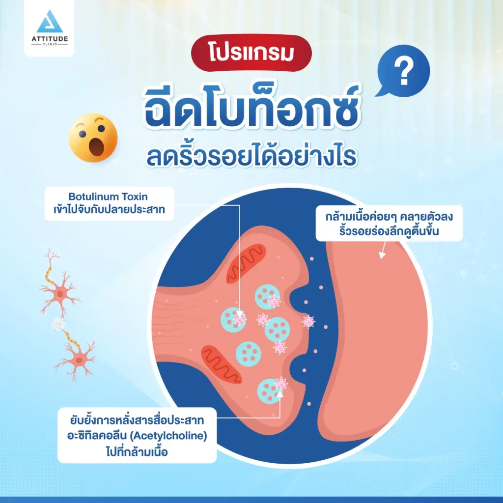 โปรแกรมฉีดโบท็อกซ์ลดริ้วรอยได้จริงหรือไม่ ?