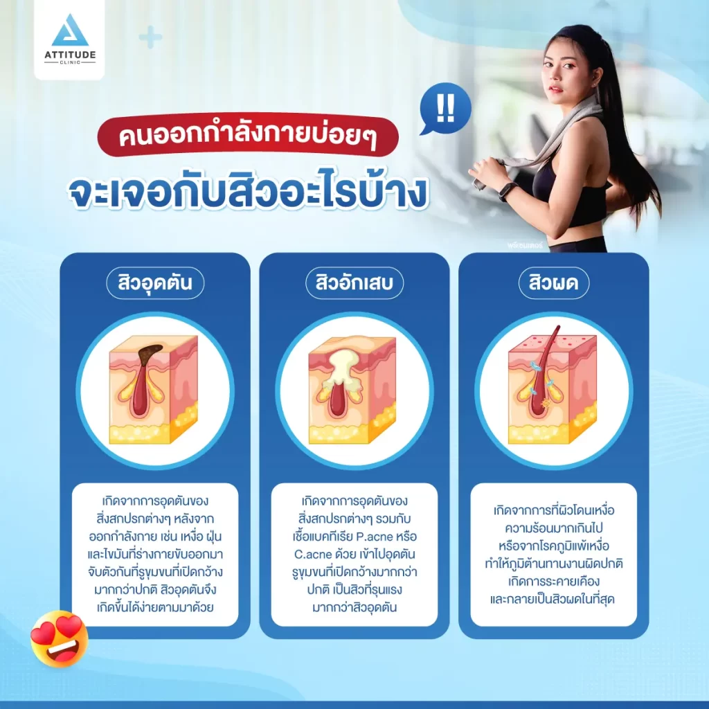 รู้ก่อน ป้องกันได้ ออกกำลังกายยังไงไม่ให้สิวบุก
