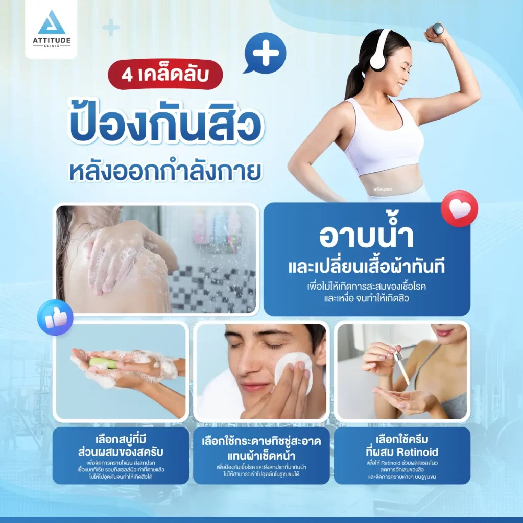 รู้ก่อน ป้องกันได้ ออกกำลังกายยังไงไม่ให้สิวบุก