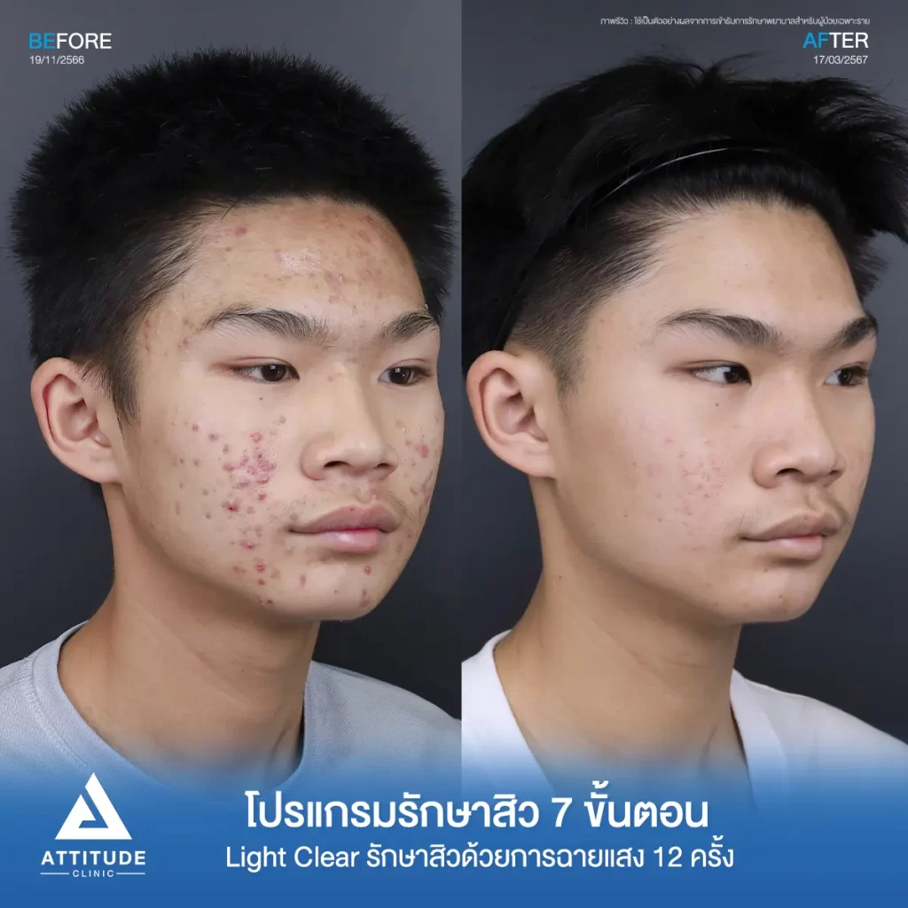 รีวิวรักษาสิวน้องไตเติ้ล ด้วยการฉายแสง โปรแกรมรักษาสิว Light Clear 7 ขั้นตอน จำนวน 12 ครั้ง ของน้องไตเติ้ล สิวอักเสบ สิวฮอร์โมน สิวอุดตัน และรอยแดงทั่วใบหน้าที่ Attitude Clinic