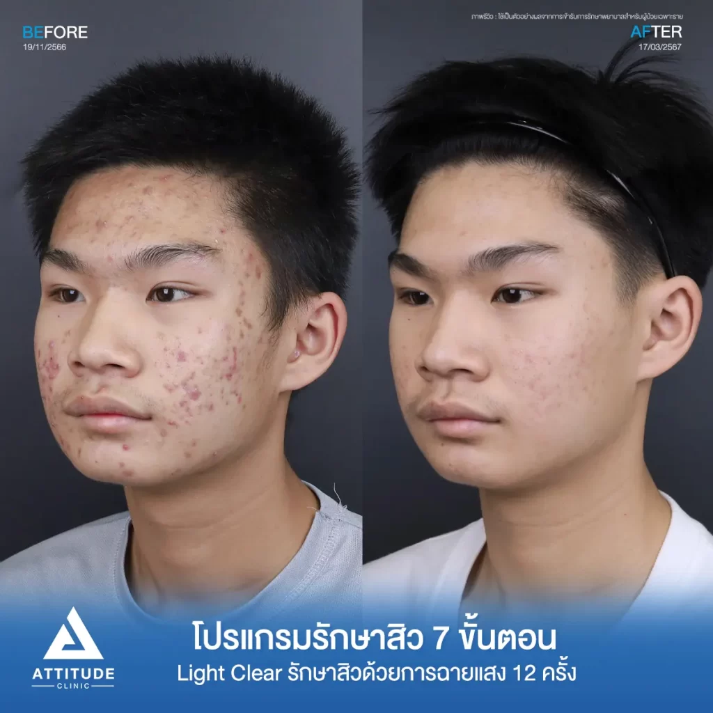 รีวิวรักษาสิวน้องไตเติ้ล ด้วยการฉายแสง โปรแกรมรักษาสิว Light Clear 7 ขั้นตอน จำนวน 12 ครั้ง ของน้องไตเติ้ล สิวอักเสบ สิวฮอร์โมน สิวอุดตัน และรอยแดงทั่วใบหน้าที่ Attitude Clinic