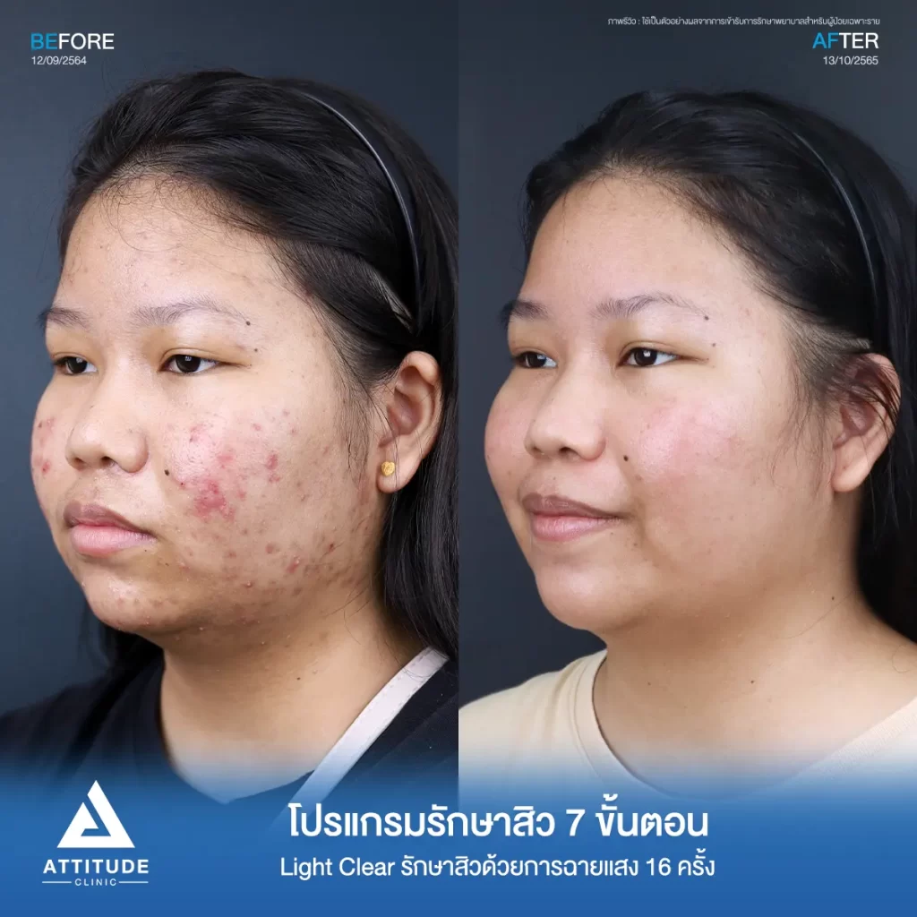 รีวิวรักษาสิวน้องฐิตาวรรณ ด้วยการฉายแสง โปรแกรมรักษาสิว Light Clear 7 ขั้นตอน จำนวน 10 ครั้ง สิวอักเสบหัวหนอง สิวอุดตัน รอยแดงทั่วใบหน้า โดยเฉพาะแก้ม 2 ข้างลามจนถึงต้นคอที่ Attitude Clinic
