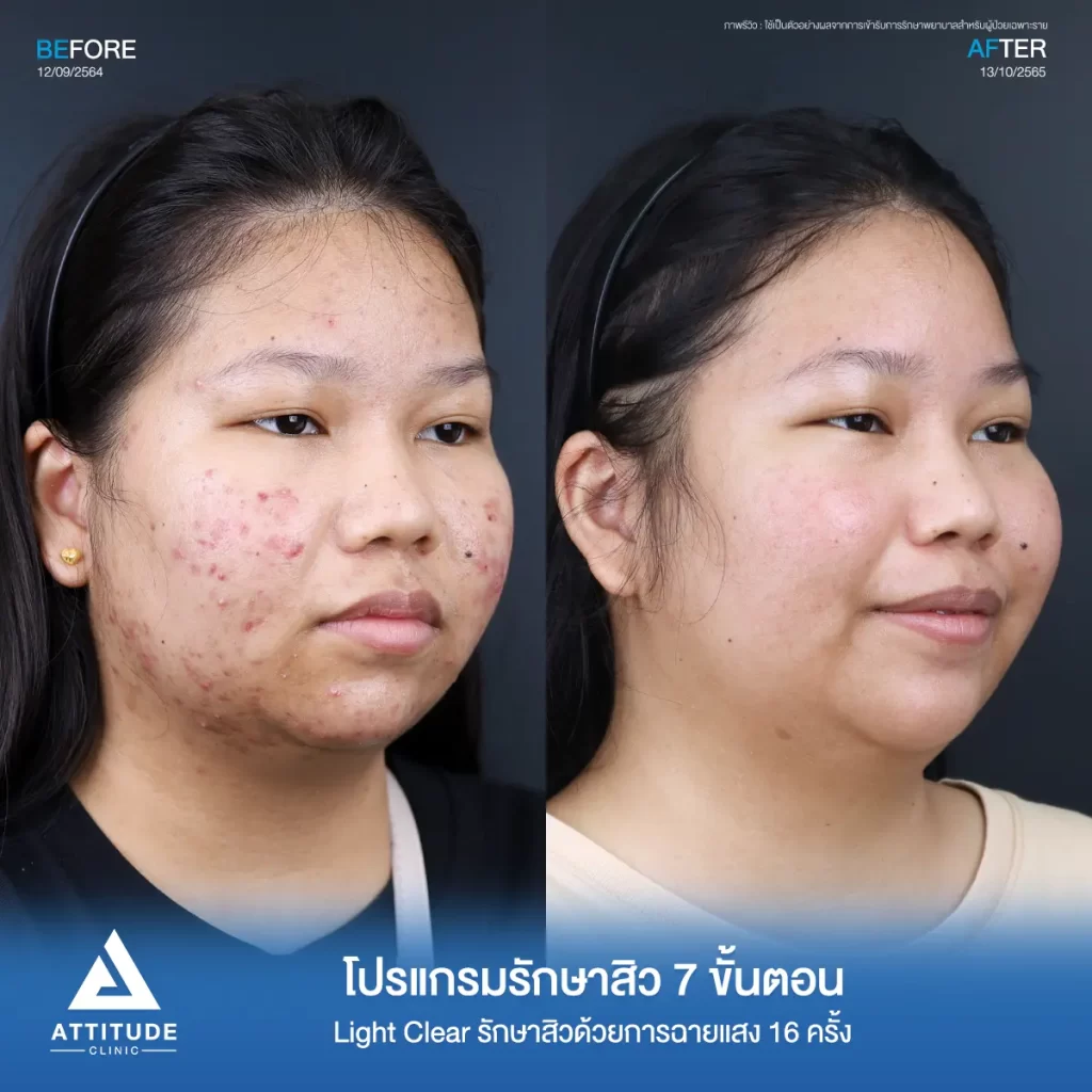 รีวิวรักษาสิวน้องฐิตาวรรณ ด้วยการฉายแสง โปรแกรมรักษาสิว Light Clear 7 ขั้นตอน จำนวน 10 ครั้ง สิวอักเสบหัวหนอง สิวอุดตัน รอยแดงทั่วใบหน้า โดยเฉพาะแก้ม 2 ข้างลามจนถึงต้นคอที่ Attitude Clinic