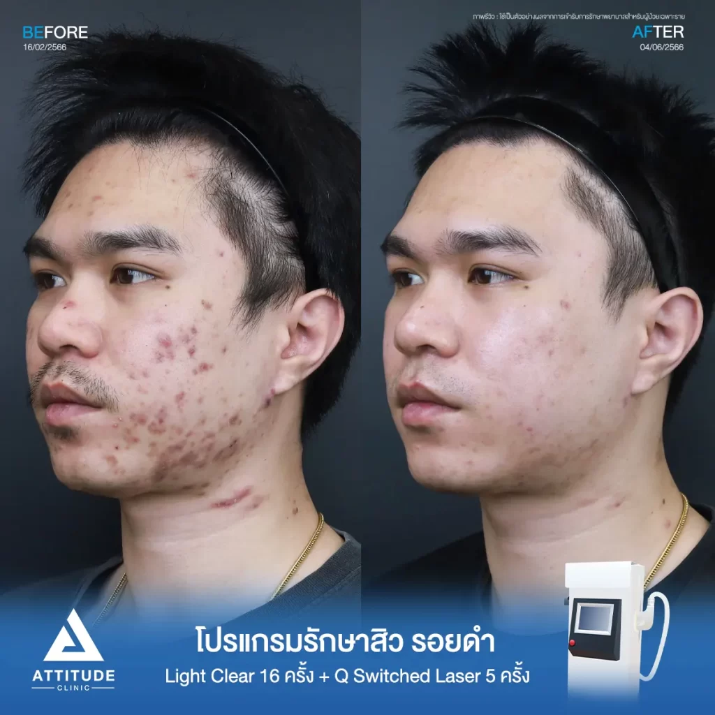 รีวิวรักษาสิวคุณนฤบดินทร์ด้วยการฉายแสง โปรแกรมรักษาสิว Light Clear 7 ขั้นตอน จำนวน 16 ครั้ง ทำ Q Switched Laser ลดรอยสิว จำนวน 5 ครั้ง รักษาสิวอุดตัน สิวอักเสบเม็ดใหญ่ รอยสิวดำจากสิวทั่วใบหน้าจนถึงคอที่ Attitude Clinic