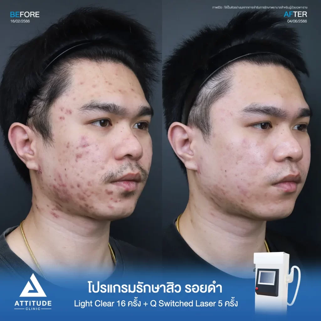 รีวิวรักษาสิวคุณนฤบดินทร์ด้วยการฉายแสง โปรแกรมรักษาสิว Light Clear 7 ขั้นตอน จำนวน 16 ครั้ง ทำ Q Switched Laser ลดรอยสิว จำนวน 5 ครั้ง รักษาสิวอุดตัน สิวอักเสบเม็ดใหญ่ รอยสิวดำจากสิวทั่วใบหน้าจนถึงคอที่ Attitude Clinic
