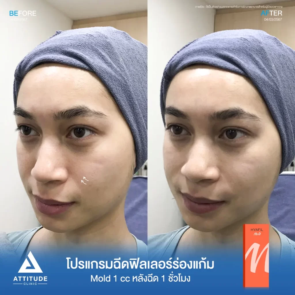 รีวิวโปรแกรมฉีดฟิลเลอร์ร่องแก้มคุณปารณีย์ รุ่น M จำนวน 1 cc หลังฉีด 1 ชั่วโมง ของคุณปารณีย์ เติมร่องแก้มให้อิ่มฟู ดูเต็มขึ้น แก้หน้าโทรมให้ดูสดใส ดูเป็นธรรมชาติที่ Attitude Clinic
