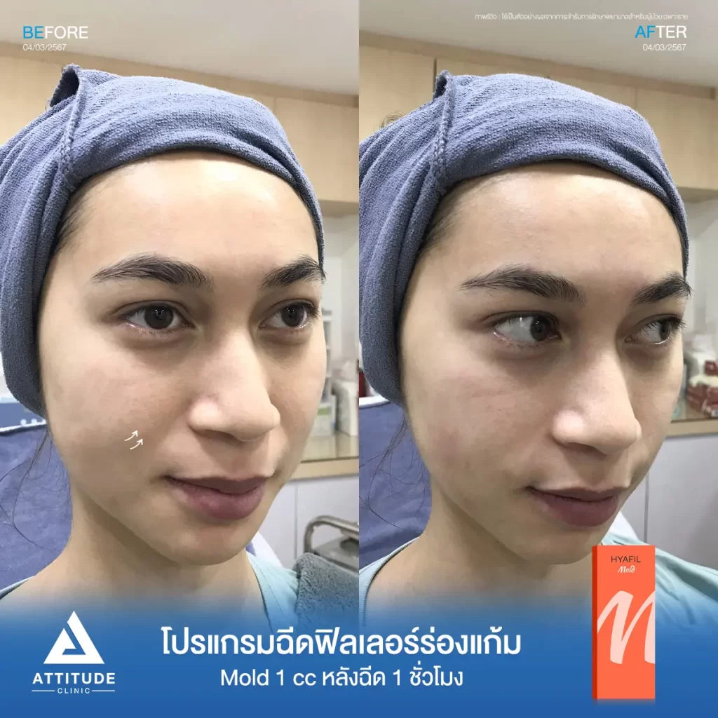 รีวิวโปรแกรมฉีดฟิลเลอร์ร่องแก้มคุณปารณีย์ รุ่น M จำนวน 1 cc หลังฉีด 1 ชั่วโมง ของคุณปารณีย์ เติมร่องแก้มให้อิ่มฟู ดูเต็มขึ้น แก้หน้าโทรมให้ดูสดใส ดูเป็นธรรมชาติที่ Attitude Clinic