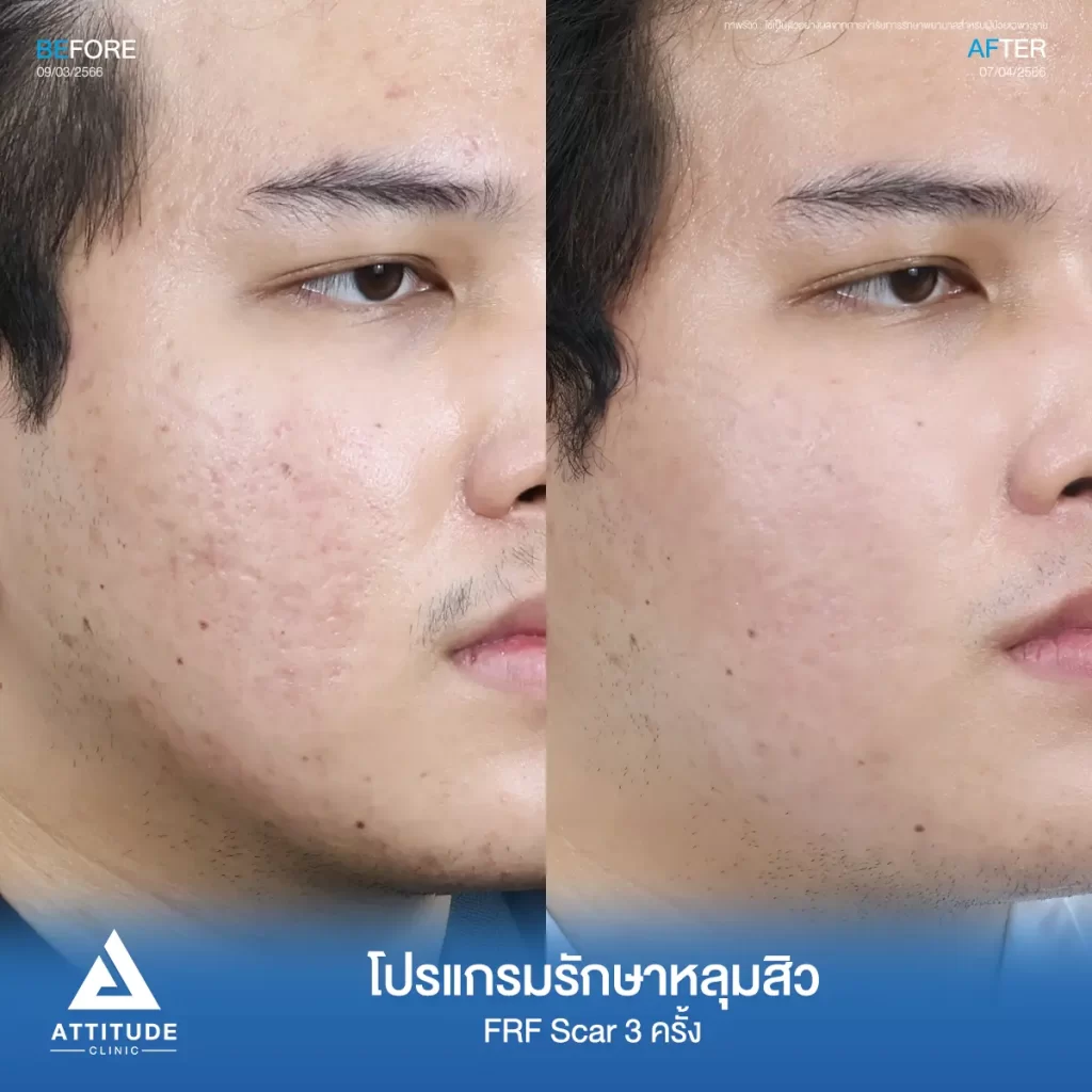 รีวิวรักษาหลุมสิวคุณเมฆ FRF Scar จำนวน 3 ครั้ง รักษาหลุมสิว กระชับรูขุมขนทั่วใบหน้า โดยเฉพาะบริเวณหน้าแก้ม 2 ข้าง และหน้าผากที่ Attitude Clinic