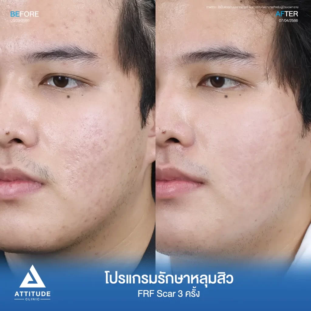 รีวิวรักษาหลุมสิวคุณเมฆ FRF Scar จำนวน 3 ครั้ง รักษาหลุมสิว กระชับรูขุมขนทั่วใบหน้า โดยเฉพาะบริเวณหน้าแก้ม 2 ข้าง และหน้าผากที่ Attitude Clinic