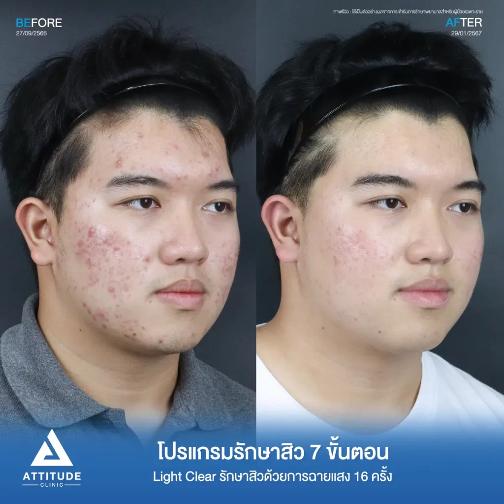 รีวิวรักษาสิวคุณบูม ด้วยการฉายแสง Light Clear 7 ขั้นตอน จำนวน 16 ครั้ง รักษาสิวฮอร์โมน สิวอักเสบ สิวอุดตัน และรอยแดงสิวทั่วใบหน้าที่ Attitude Clinic