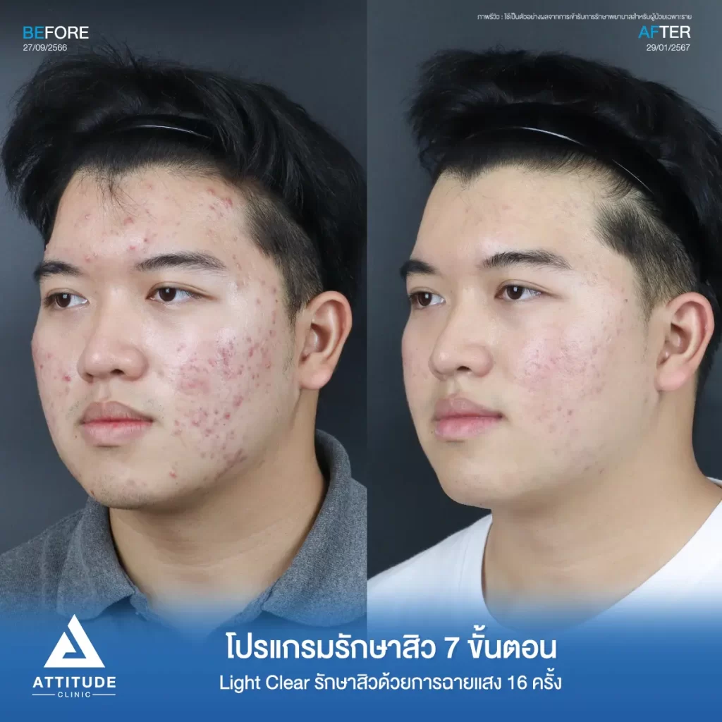 รีวิวรักษาสิวคุณบูม ด้วยการฉายแสง Light Clear 7 ขั้นตอน จำนวน 16 ครั้ง รักษาสิวฮอร์โมน สิวอักเสบ สิวอุดตัน และรอยแดงสิวทั่วใบหน้าที่ Attitude Clinic