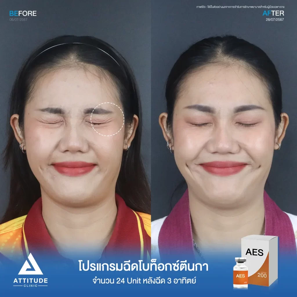 รีวิวโปรแกรมฉีดโบท็อกซ์ตีนกาคุณอีฟ จำนวน 24 Unit หลังฉีด 3 สัปดาห์ ฉีดในปริมาณที่เหมาะสมให้ริ้วรอยตีนกา และริ้วรอยเล็กๆ รอบดวงตาดูจางลง แต่หน้าดูไม่แข็งตึงกับคุณหมอที่ Attitude Clinic