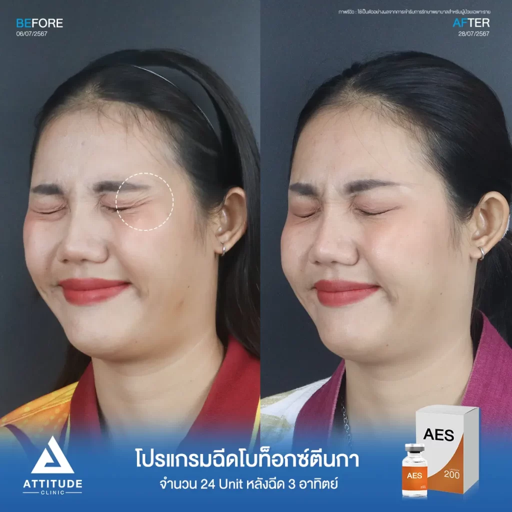 รีวิวโปรแกรมฉีดโบท็อกซ์ตีนกาคุณอีฟ จำนวน 24 Unit หลังฉีด 3 สัปดาห์ ฉีดในปริมาณที่เหมาะสมให้ริ้วรอยตีนกา และริ้วรอยเล็กๆ รอบดวงตาดูจางลง แต่หน้าดูไม่แข็งตึงกับคุณหมอที่ Attitude Clinic