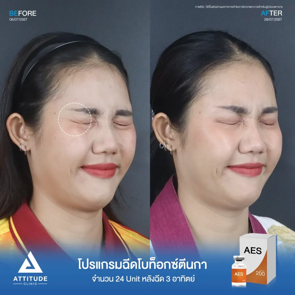 รีวิวโปรแกรมฉีดโบท็อกซ์ตีนกาคุณอีฟ จำนวน 24 Unit หลังฉีด 3 สัปดาห์ ฉีดในปริมาณที่เหมาะสมให้ริ้วรอยตีนกา และริ้วรอยเล็กๆ รอบดวงตาดูจางลง แต่หน้าดูไม่แข็งตึงกับคุณหมอที่ Attitude Clinic