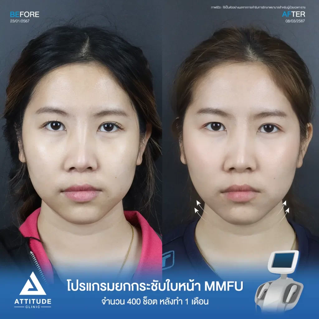 รีวิวโปรแกรมยกกระชับใบหน้า MMFU คุณปุ๊กกี้ จำนวน 400 ช็อต หลังทำ 1 เดือน ยกกระชับผิวบริเวณข้างแก้ม หน้าแก้ม เห็นกรอบหน้าชัดขึ้น หน้าเรียวสวยขึ้นที่ Attitude Clinic