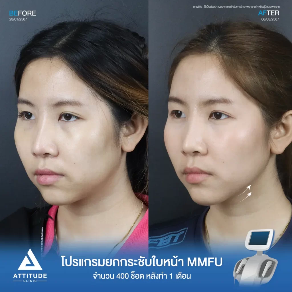 รีวิวโปรแกรมยกกระชับใบหน้า MMFU คุณปุ๊กกี้ จำนวน 400 ช็อต หลังทำ 1 เดือน ยกกระชับผิวบริเวณข้างแก้ม หน้าแก้ม เห็นกรอบหน้าชัดขึ้น หน้าเรียวสวยขึ้นที่ Attitude Clinic