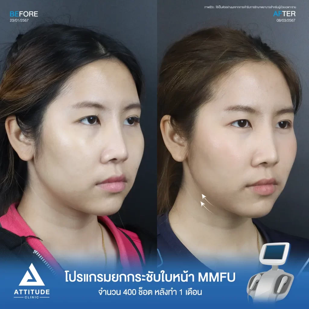 รีวิวโปรแกรมยกกระชับใบหน้า MMFU คุณปุ๊กกี้ จำนวน 400 ช็อต หลังทำ 1 เดือน ยกกระชับผิวบริเวณข้างแก้ม หน้าแก้ม เห็นกรอบหน้าชัดขึ้น หน้าเรียวสวยขึ้นที่ Attitude Clinic