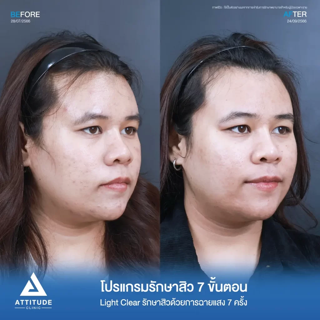 รีวิวรักษาสิวคุณบีม ด้วยการฉายแสง Light Clear 7 ขั้นตอน จำนวน 7 ครั้ง รักษาสิวอักเสบ สิวอุดตัน รอยสิวทั่วใบหน้าที่ Attitude Clinic