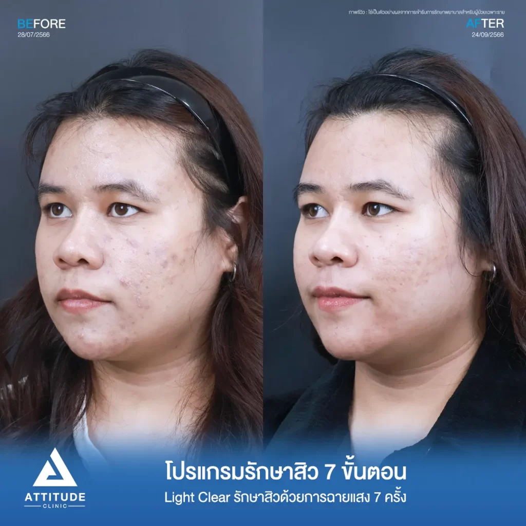 รีวิวรักษาสิวคุณบีม ด้วยการฉายแสง Light Clear 7 ขั้นตอน จำนวน 7 ครั้ง รักษาสิวอักเสบ สิวอุดตัน รอยสิวทั่วใบหน้าที่ Attitude Clinic