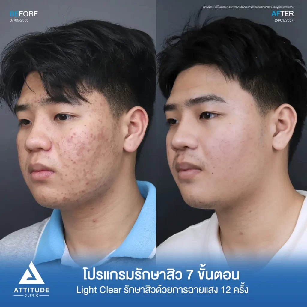 รีวิวรักษาสิวคุณชัยวัตร ด้วยการฉายแสง โปรแกรมรักษาสิว Light Clear 7 ขั้นตอน จำนวน 12 ครั้ง รักษาสิวอักเสบ สิวฮอร์ สิวอุดตัน และรอยสิวสิวทั่วใบหน้าที่ Attitude Clinic