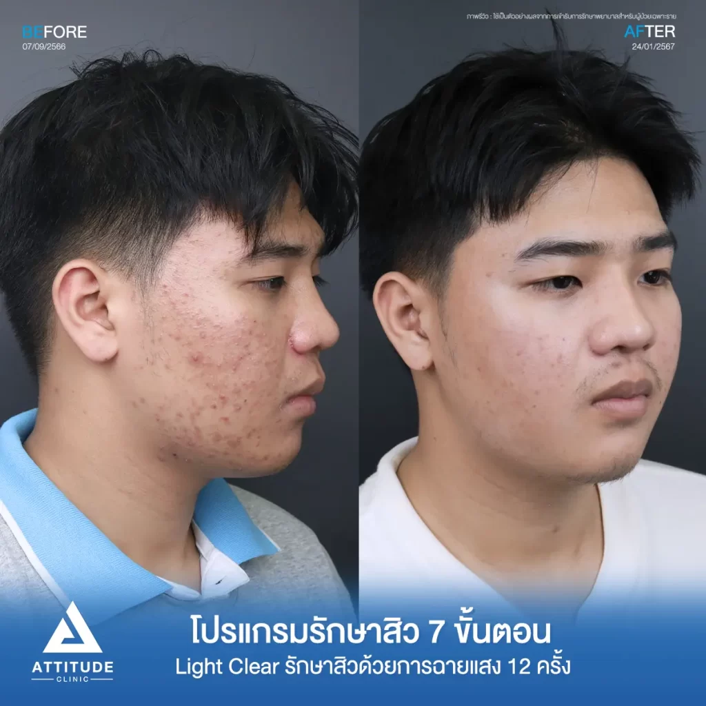 รีวิวรักษาสิวคุณชัยวัตร ด้วยการฉายแสง โปรแกรมรักษาสิว Light Clear 7 ขั้นตอน จำนวน 12 ครั้ง รักษาสิวอักเสบ สิวฮอร์ สิวอุดตัน และรอยสิวสิวทั่วใบหน้าที่ Attitude Clinic