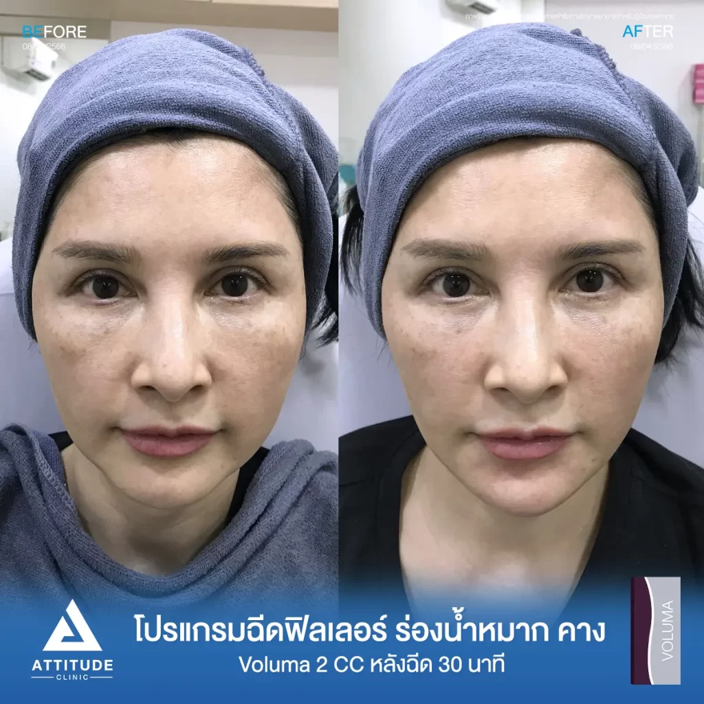 รีวิวโปรแกรมฉีดฟิลเลอร์ร่องน้ำหมาก คางคุณมงกฎรุ่น Voluma จำนวน 2 cc หลังฉีด 30 นาทีเติมเต็มปรับรูปหน้า แก้ปัญหาร่องลึกให้กลับมาอิ่มฟู ให้หน้ากลับมาสดใส เติมเต็มคางให้เรียวยาวได้รูปตามต้องการที่ Attitude Clinic