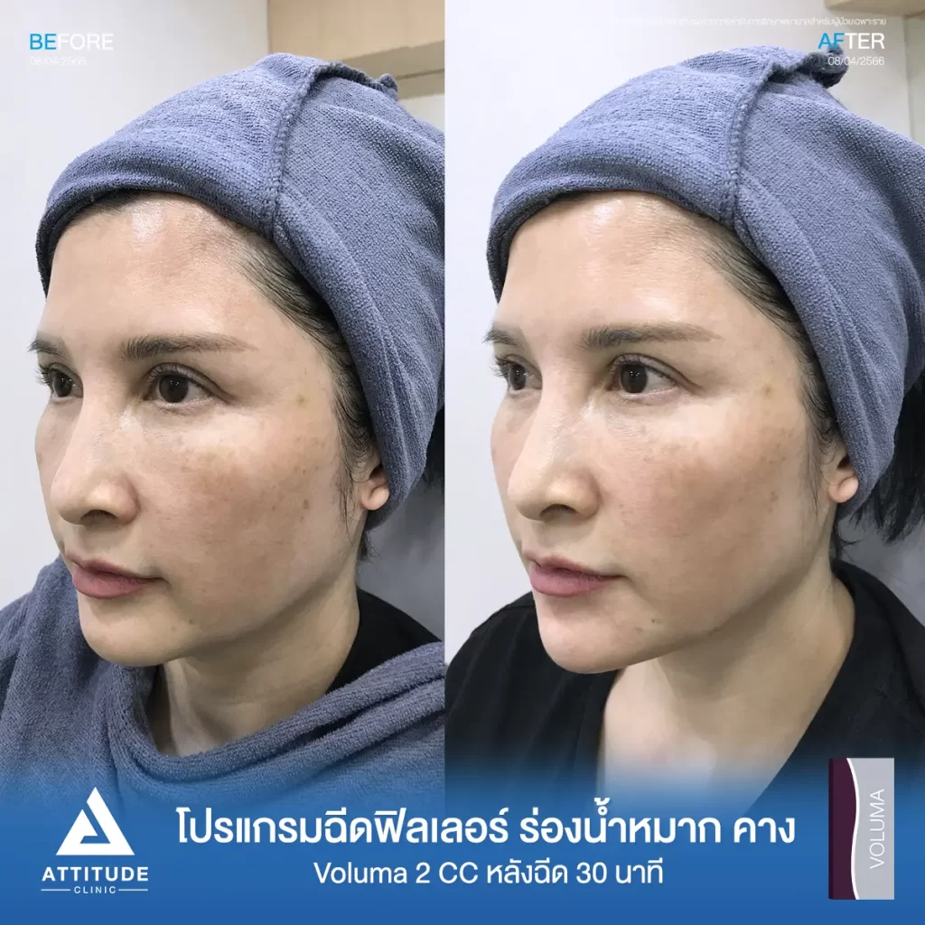รีวิวโปรแกรมฉีดฟิลเลอร์ร่องน้ำหมาก คางคุณมงกฎรุ่น Voluma จำนวน 2 cc หลังฉีด 30 นาทีเติมเต็มปรับรูปหน้า แก้ปัญหาร่องลึกให้กลับมาอิ่มฟู ให้หน้ากลับมาสดใส เติมเต็มคางให้เรียวยาวได้รูปตามต้องการที่ Attitude Clinic