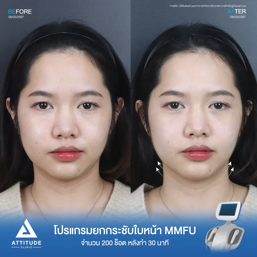 รีวิวโปรแกรมยกกระชับใบหน้า MMFU คุณแป้งร่ำ จำนวน 200 ช็อต หลังทำ 30 นาที ยกกระชับผิว และสลายไขมันบริเวณข้างแก้ม หน้าแก้ม เก็บเหนียงใต้คาง หน้าดูเรียวขึ้น เห็นกรอบหน้าชัดขึ้นที่ Attitude Clinic