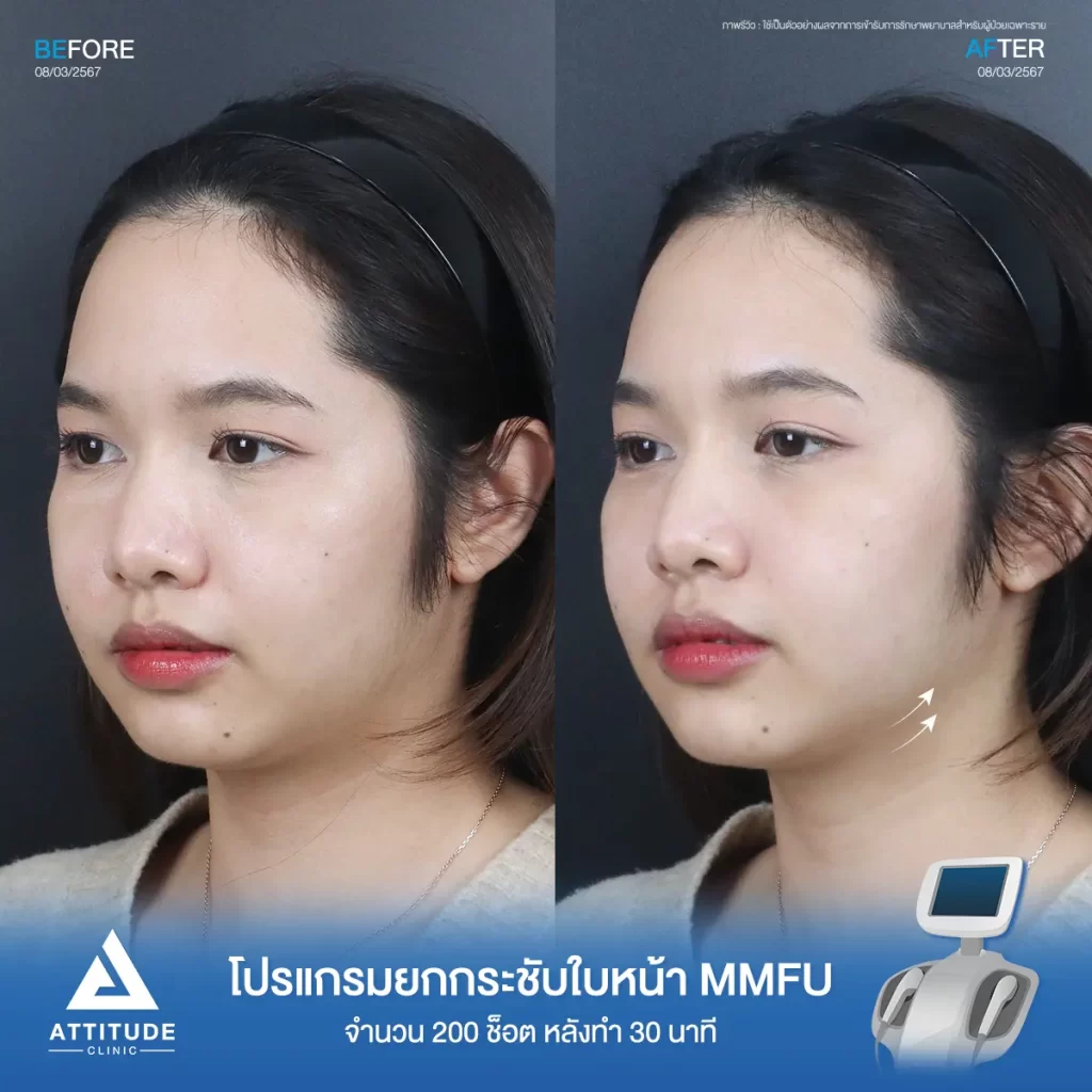 รีวิวโปรแกรมยกกระชับใบหน้า MMFU คุณแป้งร่ำ จำนวน 200 ช็อต หลังทำ 30 นาที ยกกระชับผิว และสลายไขมันบริเวณข้างแก้ม หน้าแก้ม เก็บเหนียงใต้คาง หน้าดูเรียวขึ้น เห็นกรอบหน้าชัดขึ้นที่ Attitude Clinic