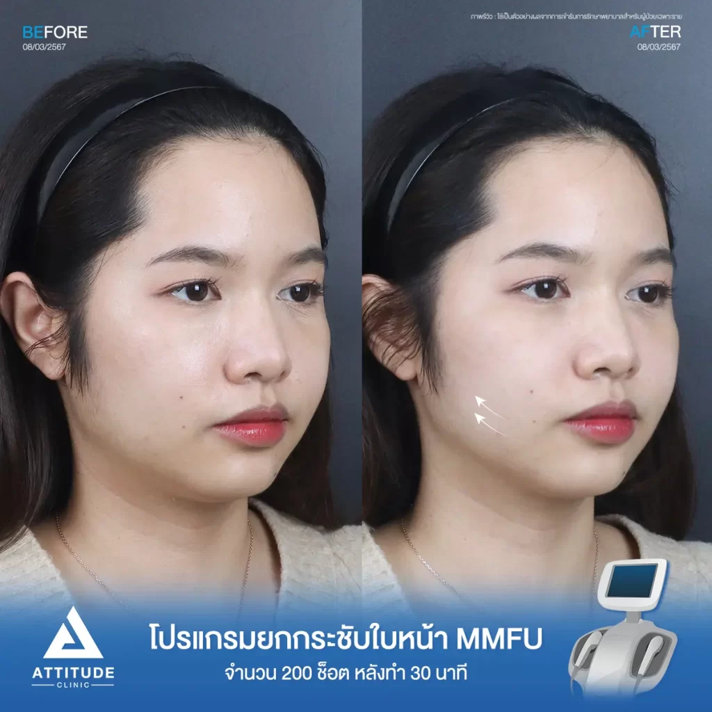 รีวิวโปรแกรมยกกระชับใบหน้า MMFU คุณแป้งร่ำ จำนวน 200 ช็อต หลังทำ 30 นาที ยกกระชับผิว และสลายไขมันบริเวณข้างแก้ม หน้าแก้ม เก็บเหนียงใต้คาง หน้าดูเรียวขึ้น เห็นกรอบหน้าชัดขึ้นที่ Attitude Clinic