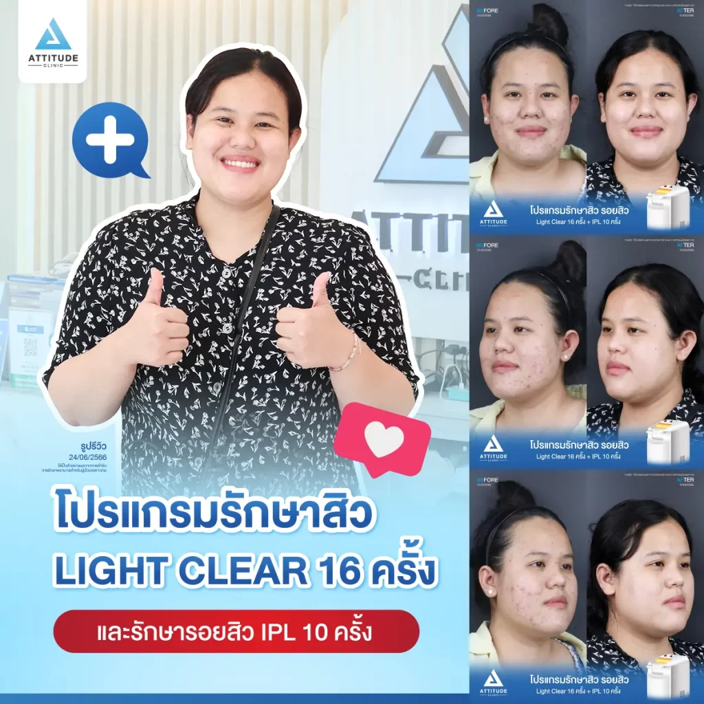 รีวิวรักษาสิวคุณนุ่น ด้วยการฉายแสง โปรแกรมรักษาสิว Light Clear 7 ขั้นตอน จำนวน 16 ครั้ง และโปรแกรม IPL หน้าใส จำนวน 10 ครั้ง รักษาสิวอักเสบ สิวอุดตัน และรอยแดงสิวทั่วใบหน้าที่ Attitude Clinic