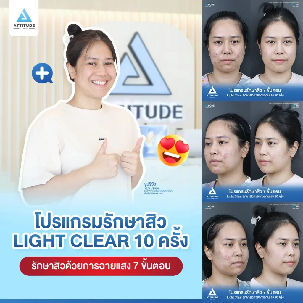 รีวิวรักษาสิวคุณเอ ด้วยการฉายแสง โปรแกรมรักษาสิว Light Clear 7 ขั้นตอน จำนวน 10 ครั้ง รักษาสิวอักเสบ สิวหัวหนองเม็ดใหญ่ๆ บริเวณแก้มสองข้าง และคางที่ Attitude Clinic