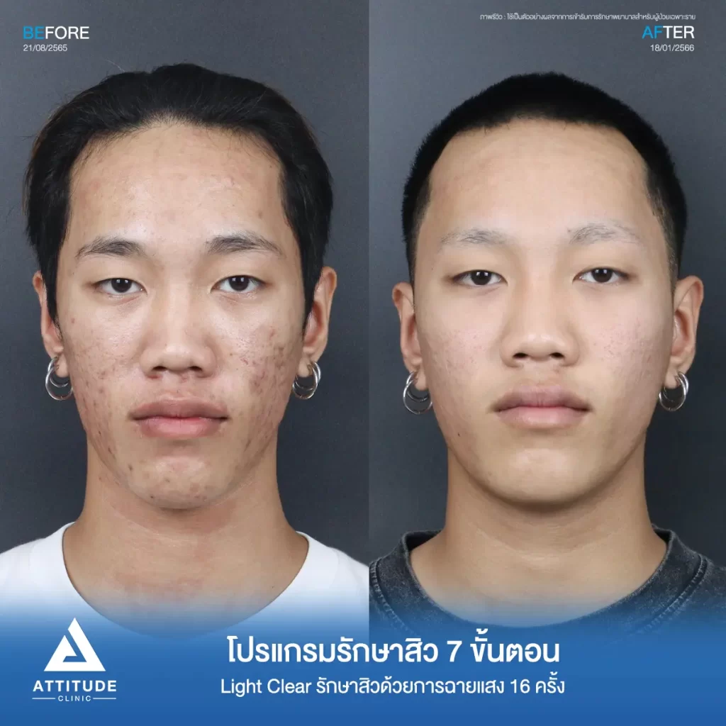 รีวิวรักษาสิวคุณเทม ด้วยการฉายแสง โปรแกรมรักษาสิว Light Clear 7 ขั้นตอน จำนวน 16 ครั้ง รักษาสิวอุดตัน สิวอักเสบ รอยแดงทั่วใบหน้าโดยเฉพาะบริเวณแก้ม 2 ข้างที่ Attitude Clinic