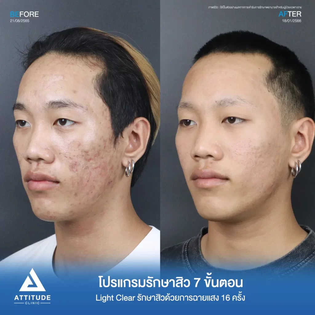 รีวิวรักษาสิวคุณเทม ด้วยการฉายแสง โปรแกรมรักษาสิว Light Clear 7 ขั้นตอน จำนวน 16 ครั้ง รักษาสิวอุดตัน สิวอักเสบ รอยแดงทั่วใบหน้าโดยเฉพาะบริเวณแก้ม 2 ข้างที่ Attitude Clinic