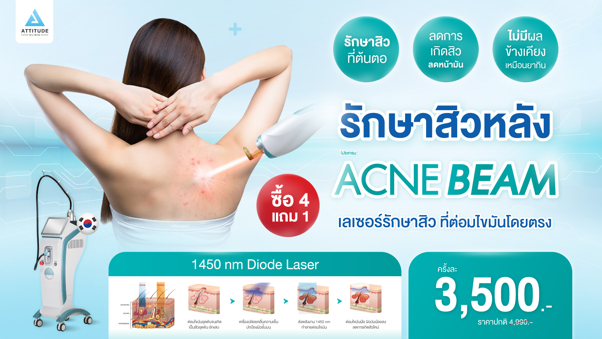 โปรโมชั่นราคาเลเซอร์รักษาสิว ที่หลัง Neobeam 1450 nm laser