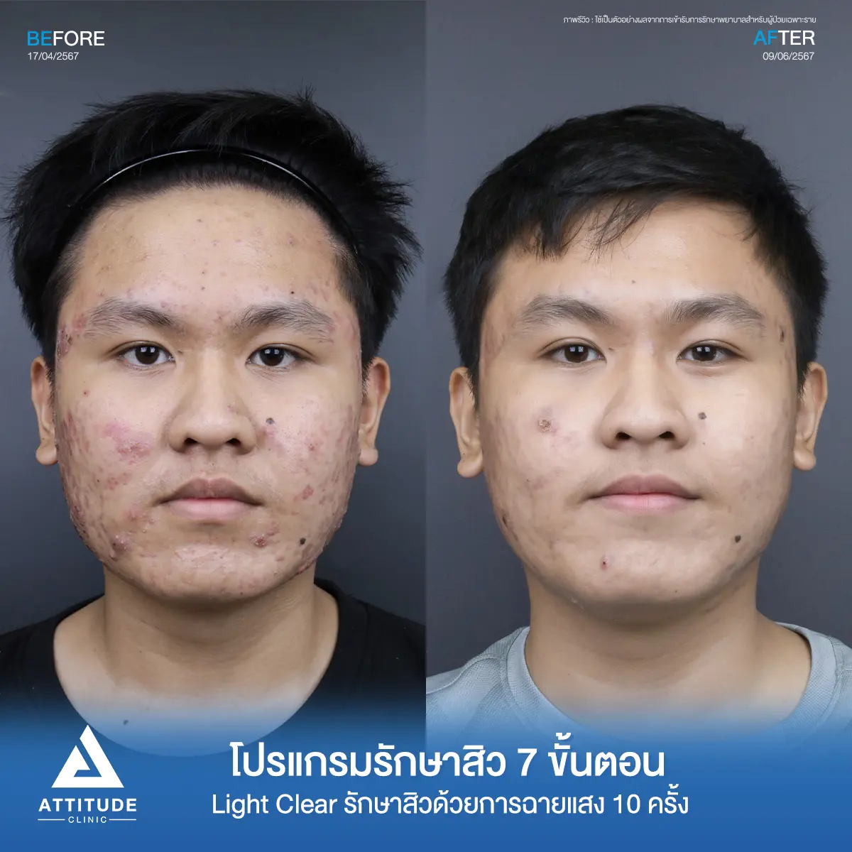 รีวิวรักษาสิวคุณอดิศร ด้วยการฉายแสง โปรแกรมรักษาสิว Light Clear 7 ขั้นตอน จำนวน 10 ครั้ง รักษาสิวอักเสบเม็ดใหญ่ สิวหนอง รอยแดงทั่วใบหน้าโดยเฉพาะข้างแก้มทั้ง 2 ด้านที่ Attitude Clinic