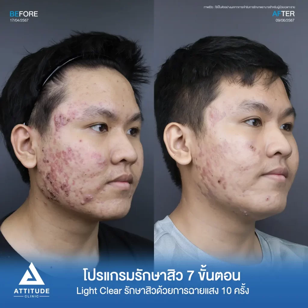 รีวิวรักษาสิวคุณอดิศร ด้วยการฉายแสง โปรแกรมรักษาสิว Light Clear 7 ขั้นตอน จำนวน 10 ครั้ง รักษาสิวอักเสบเม็ดใหญ่ สิวหนอง รอยแดงทั่วใบหน้าโดยเฉพาะข้างแก้มทั้ง 2 ด้านที่ Attitude Clinic