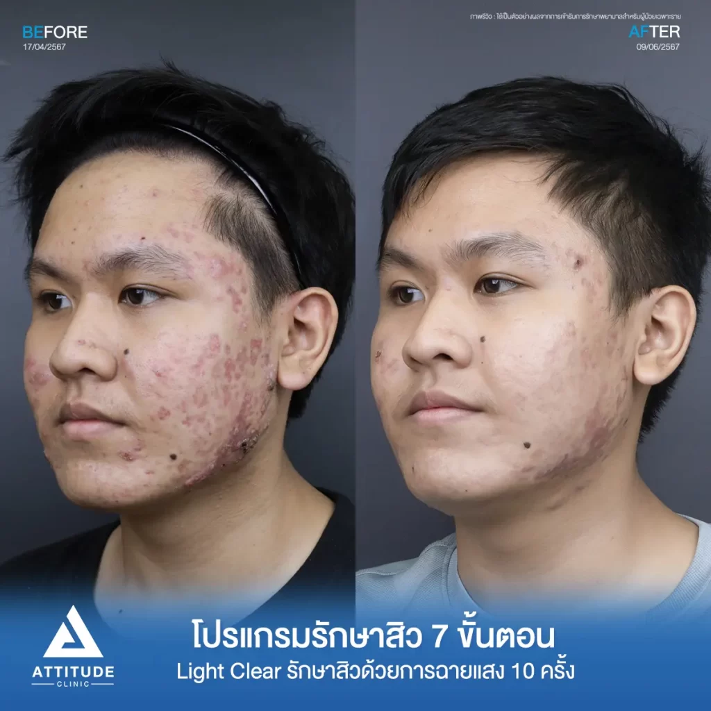 รีวิวรักษาสิวคุณอดิศร ด้วยการฉายแสง โปรแกรมรักษาสิว Light Clear 7 ขั้นตอน จำนวน 10 ครั้ง รักษาสิวอักเสบเม็ดใหญ่ สิวหนอง รอยแดงทั่วใบหน้าโดยเฉพาะข้างแก้มทั้ง 2 ด้านที่ Attitude Clinic